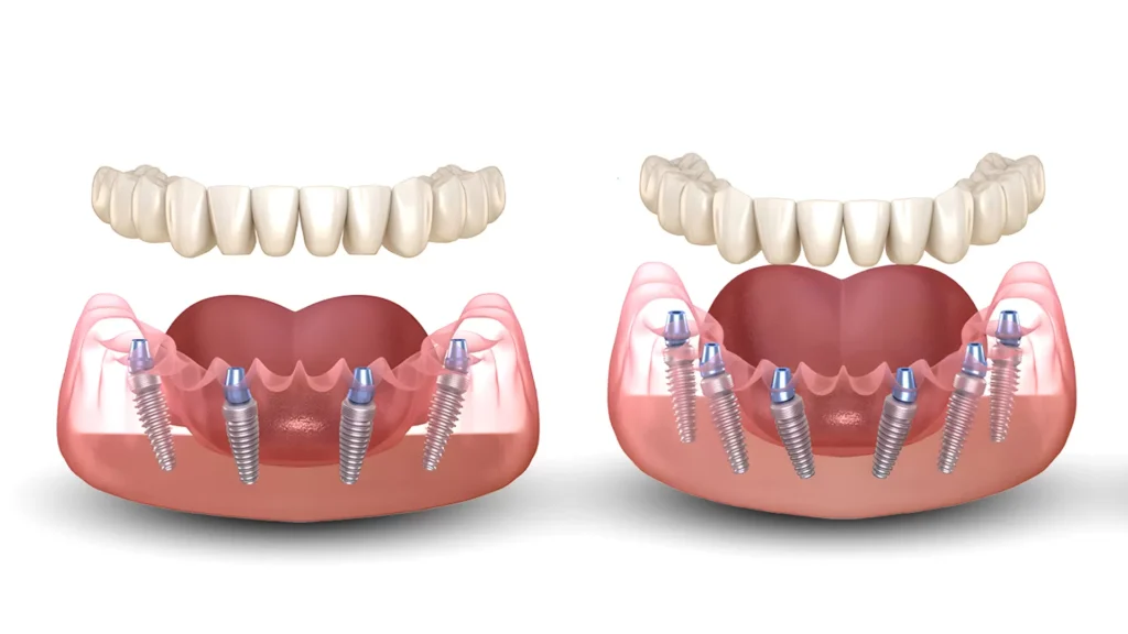 Tutto su 4 vs tutto su 6: quale soluzione implantare a tutto arco è giusta per te?