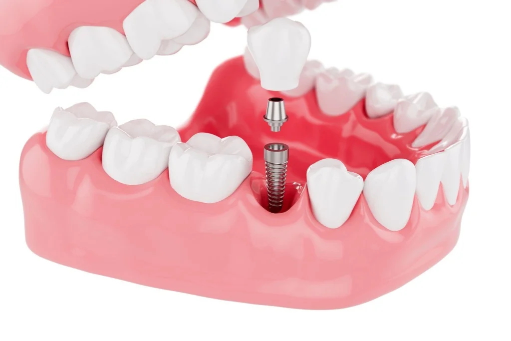 Albania Dental Implants - thirty2dental clinic