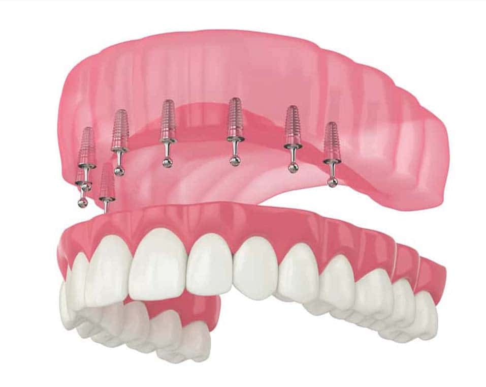 Albania Dental Implants- thirty2dental tourism